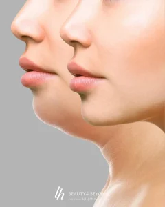 Zašto je podbradak postao najutjecajniji detalj ljepote lica i kako ga napredna estetika rješava bez noža?