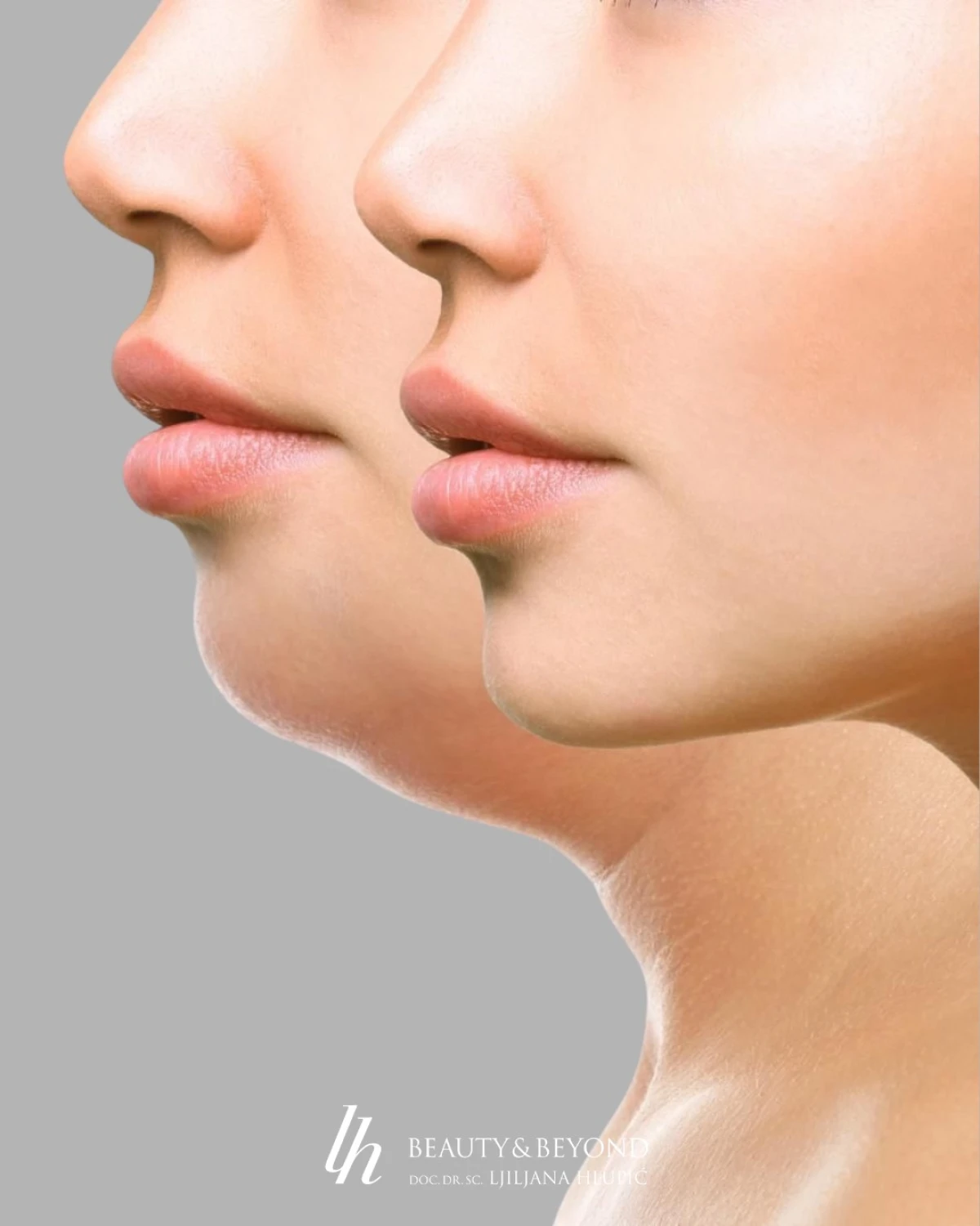 Zašto je podbradak postao najutjecajniji detalj ljepote lica i kako ga napredna estetika rješava bez noža?